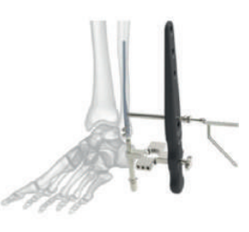 Малогомілковий цвях Changzhou Nanxiang Medical Device Co., Ltd.